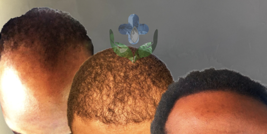 afro hair transplant colombia